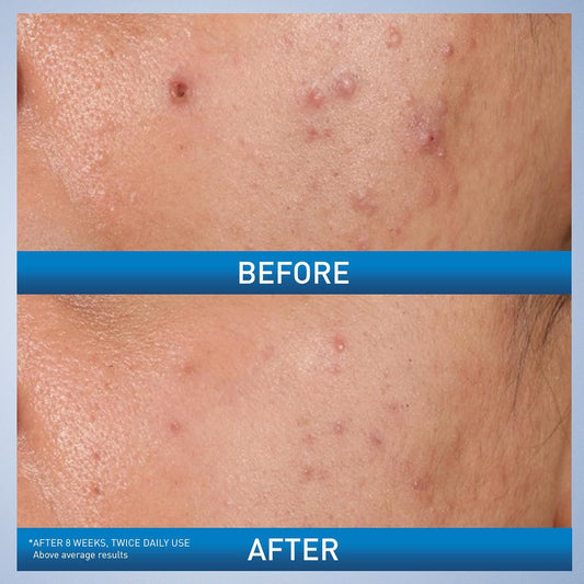 glycolic acid and lactic acid (ahas) blend for surface exfoliation and smoother texture