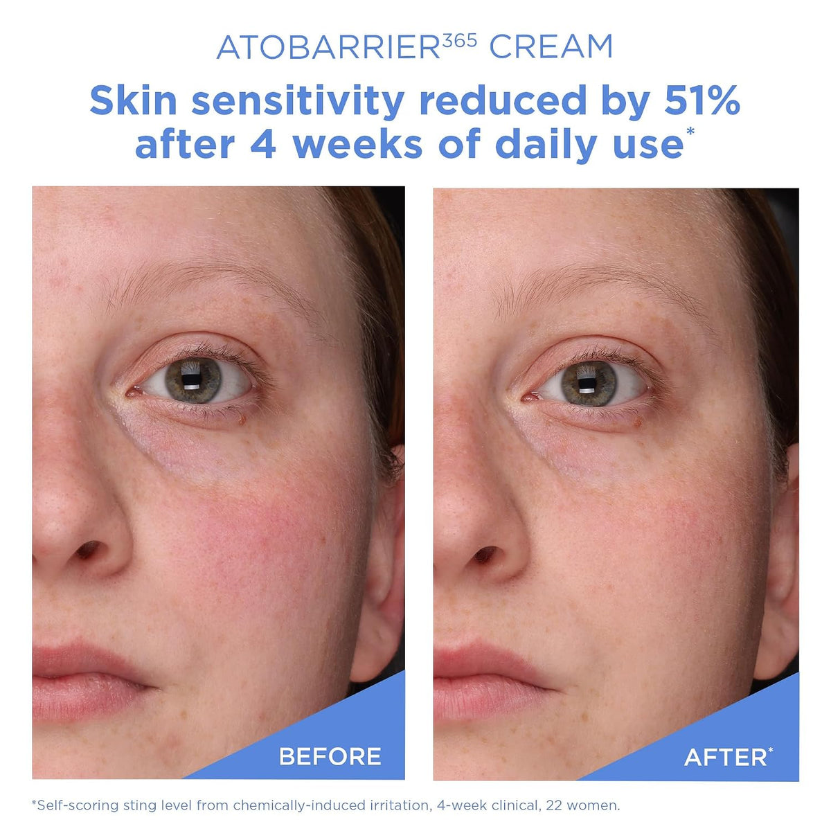 accepted by the national eczema association and suitable after microneedling
