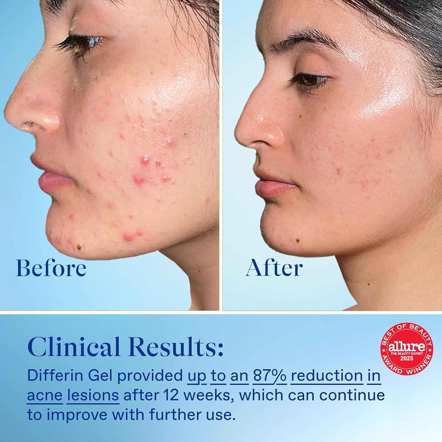 dermatologist-recommended formula designed for superior tolerability vs. other retinoids