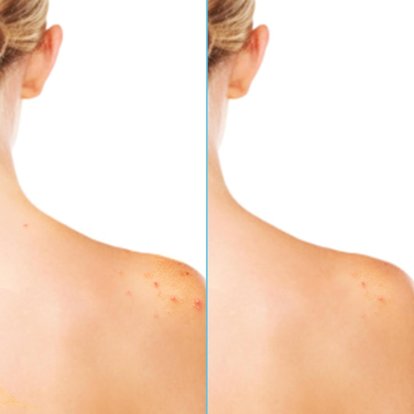 Differin Acne Body Spray – Travel-Sized Back Acne Treatment for Beach Days and Camping Trips, 6 oz Mist