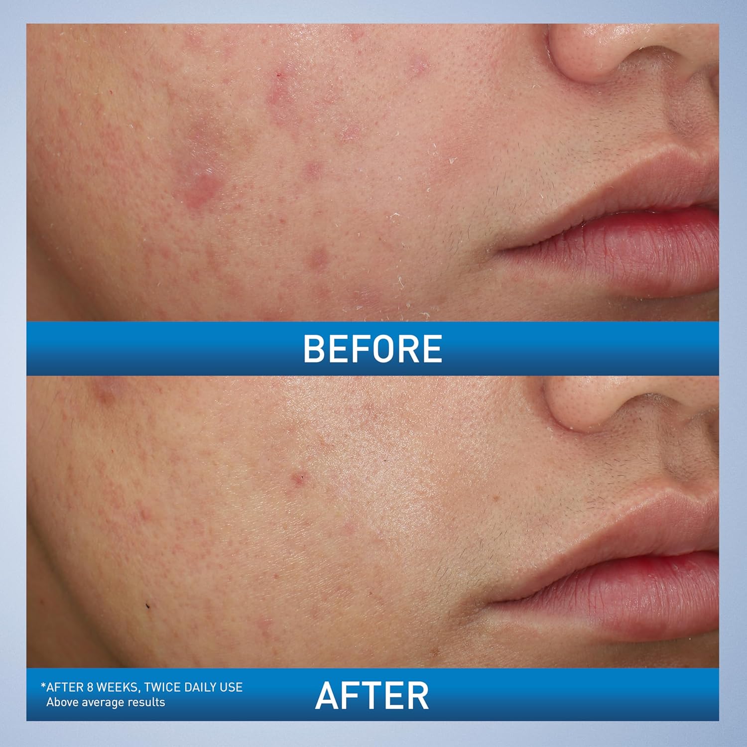 hyaluronic acid to attract and retain skin hydration during treatment