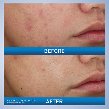 hyaluronic acid to attract and retain skin hydration during treatment