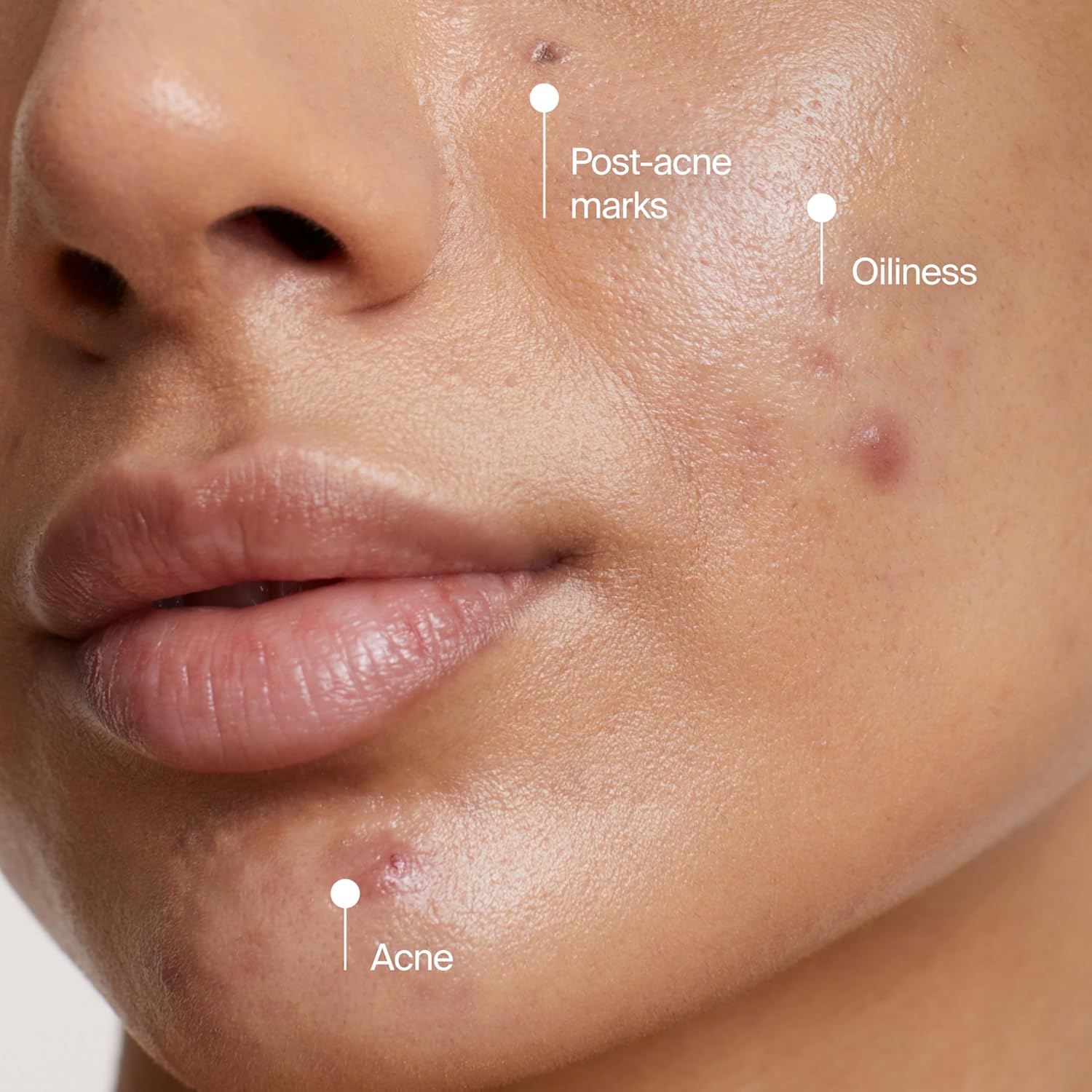 Neutrogena Evenly Clear Acne Cleansing Face Mask with 3.5% Benzoyl Peroxide – Mindful Shower Skincare Ritual for Clearer, Balanced Skin